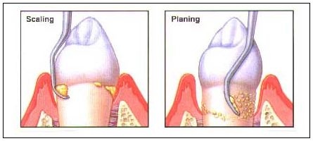 scaling and root planing manchester nh dentist