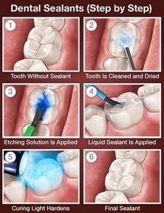 Pediatric Dentistry Sealants | Manchester NH Dentist